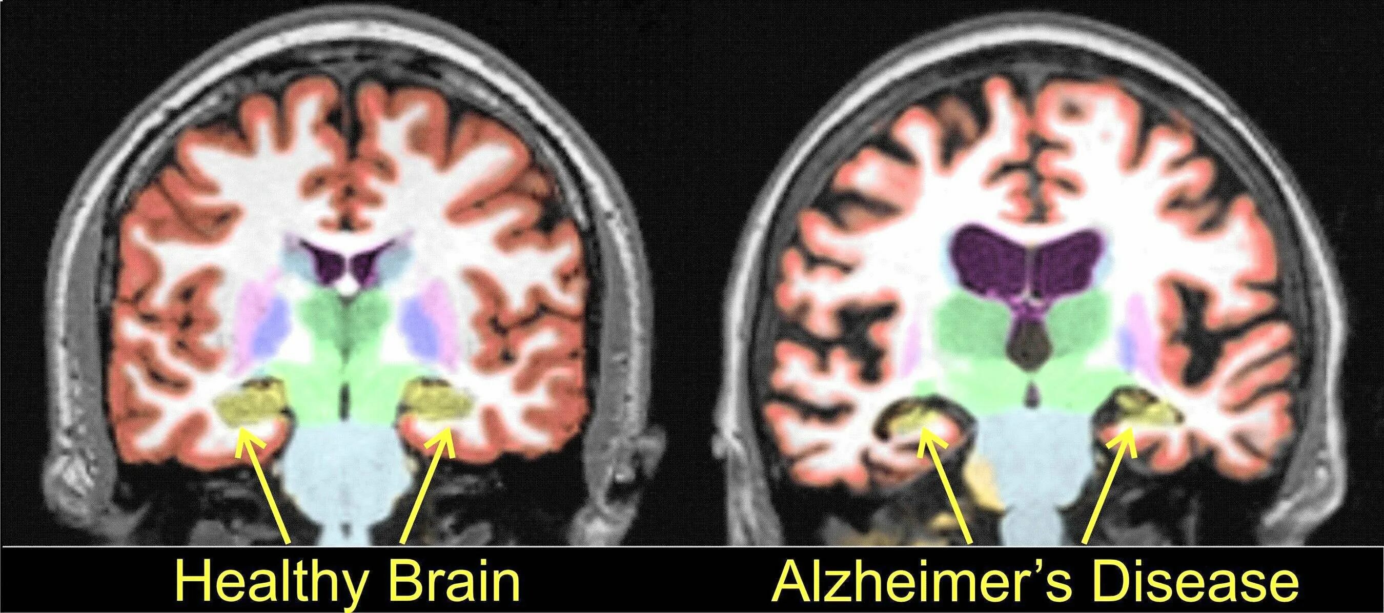 Кт и мрт при болезни альцгеймера. Болезнь альцгеймера мрт. Кт и мрт при болезни альцгеймера. Мрт головного мозга при болезни альцгеймера. Болезнь альцгеймера снимки мрт.