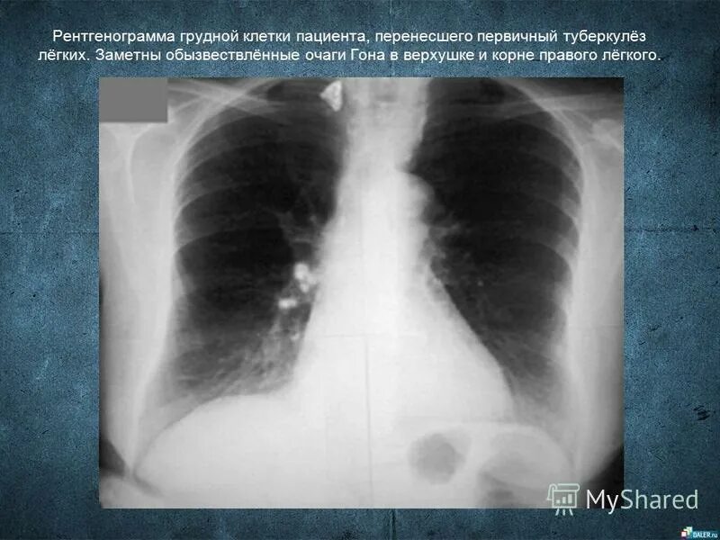 Кальцинат в легком рентгенограмма. Кальцинат легких что это такое простыми. Множественные кальцинаты в легких рентген. Кальцинат легких что это такое простыми. Кальцинат легких что это такое простыми.