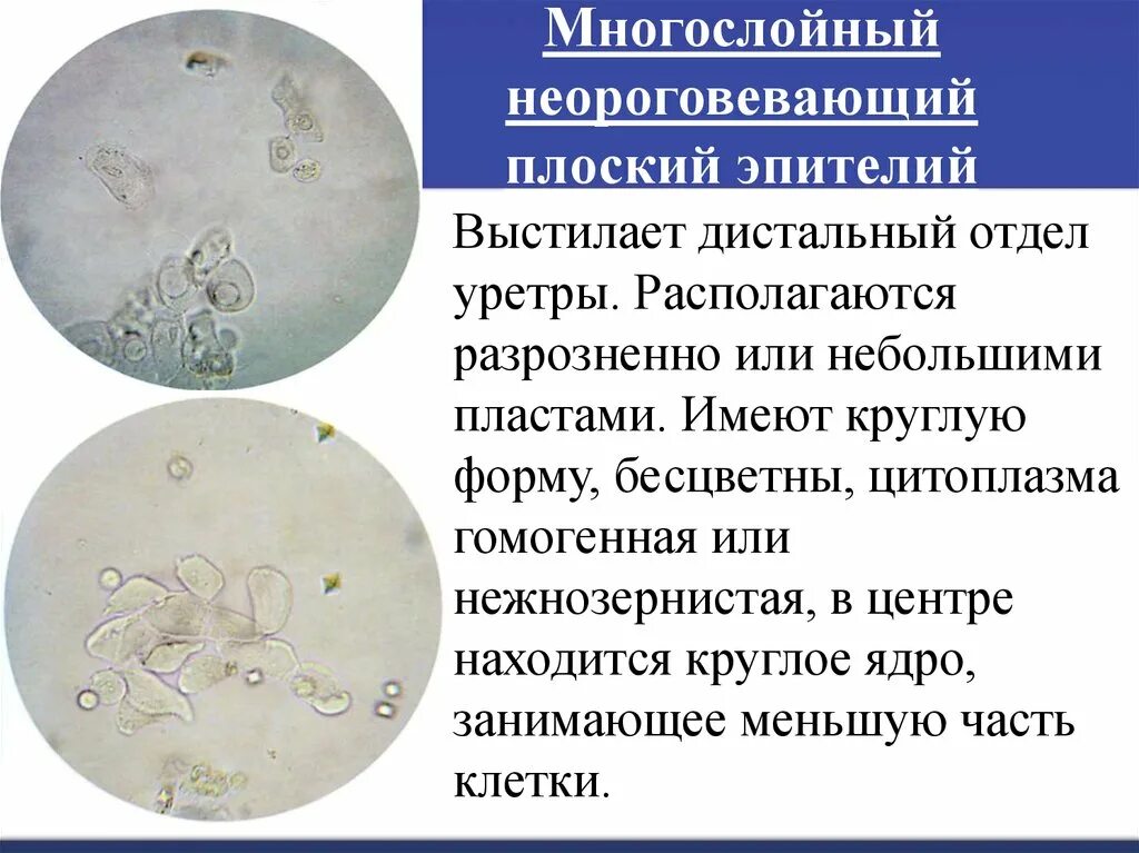 Микроскопия мочи эпителий плоский. Многослойный плоский неороговевающий эпителий в осадке мочи. Плоский эпителий в моче микроскопия. Плоский эпителий микроскопия мочевого осадка. Повышенный эпителий в моче у мужчин