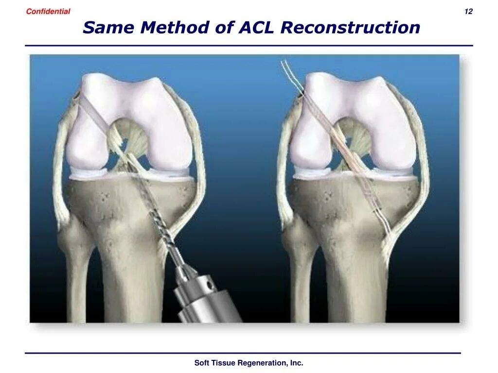 Операция разрыв мениска и передней крестообразной связки. Разрыв ПКС коленного сустава. Операция ПКС коленного сустава.