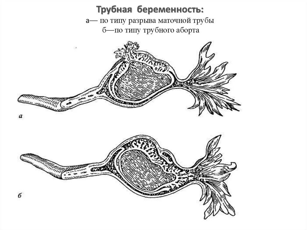 Эктопическая Трубная беременность. Формы прерывания трубной беременности. Внематочная Трубная беременность по типу трубного аборта. Нарушенная Трубная беременность по типу разрыва трубы.