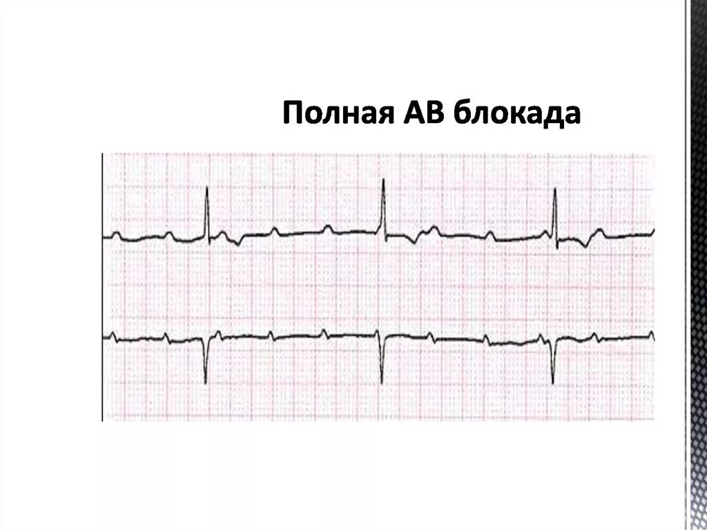 Блокада узла. Полная av блокада на ЭКГ. Полная атриовентрикулярная блокада на ЭКГ. Полная av блокада на ЭКГ 3 степени. АВ блокада 4 степени на ЭКГ.