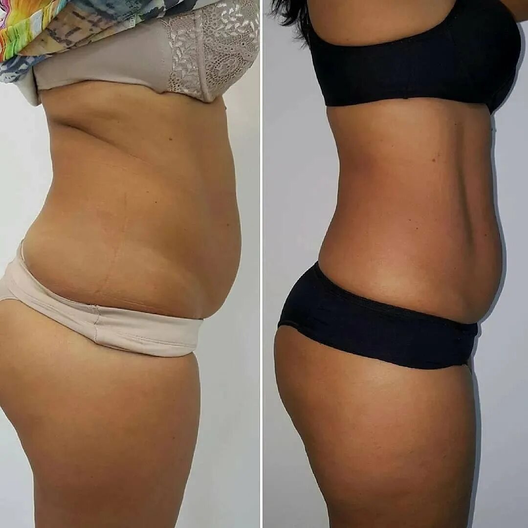 криолиполиз результаты. процедура криолиполиза. криолиполиз результаты. криолиполиз результаты. криолиполиз живота до и после 1 процедуры.