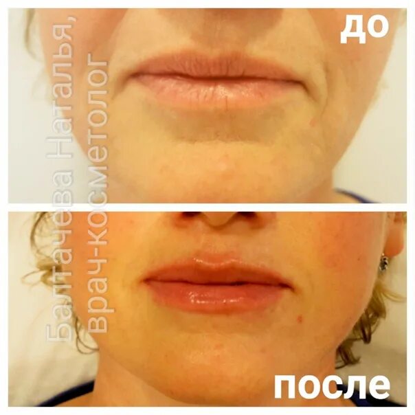 Губы 1 мл отзывы Shtampik.com