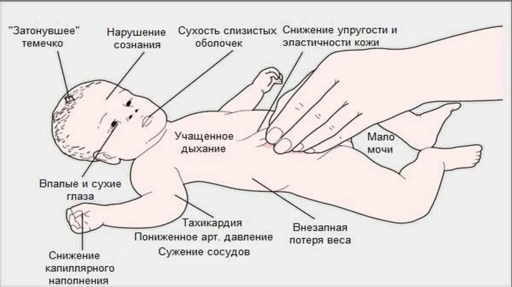 Обезвоживание у ребенка 3. Признаки обезвоживания у ребенка 1 год. Симптомы обезвоживания у ребенка при ротовирусе. Обезвоживание организма у ребенка симптомы 1 год. Как проявляется обезвоживание у грудничка.