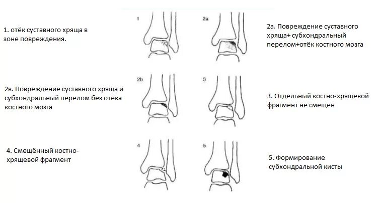 Отек мыщелка бедренной. Стадии остеохондрального повреждения таранной кости. Классификация переломов большеберцовой кости по АО. Переломы таранной кости классификация АО. Импрессионный перелом коленного сустава мрт.