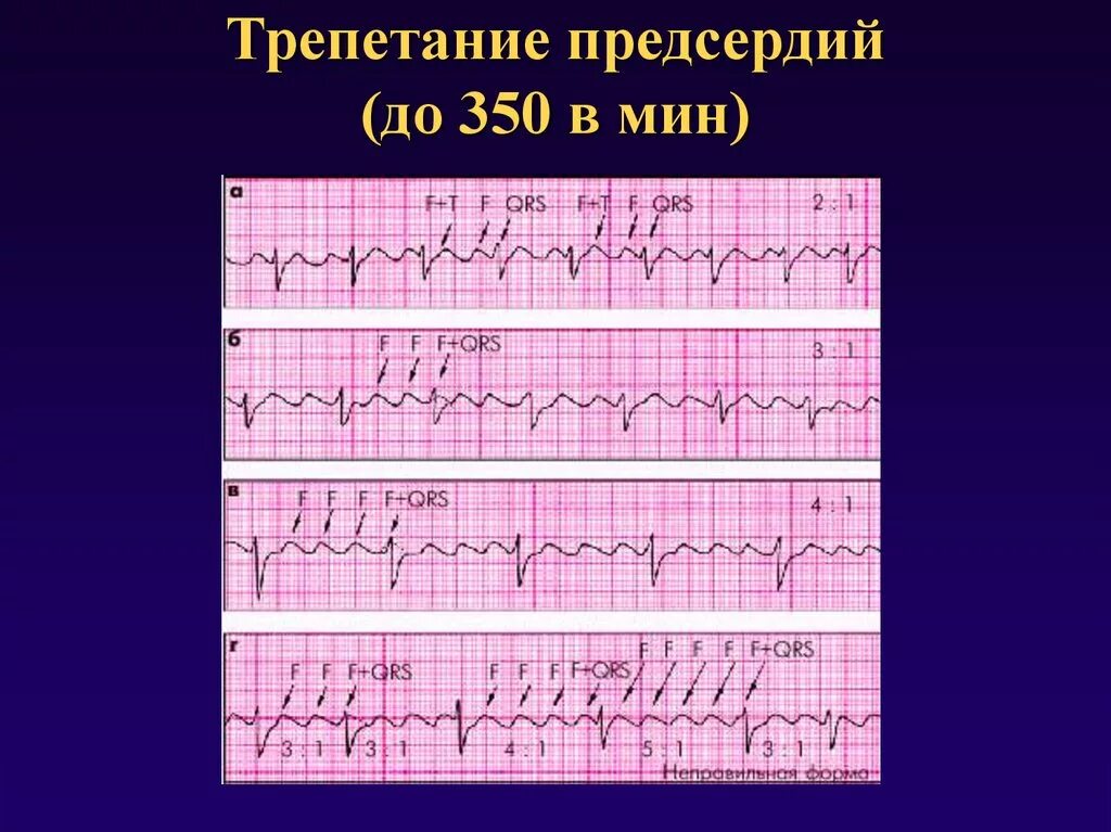 Трепетание предсердий 2 1. Трепетание предсердий 1 к 1 на экг. трепетание предсердий 2 к 1 на экг. пароксизм трепетания предсердий экг. трепетание предсердий атипичная форма на экг.