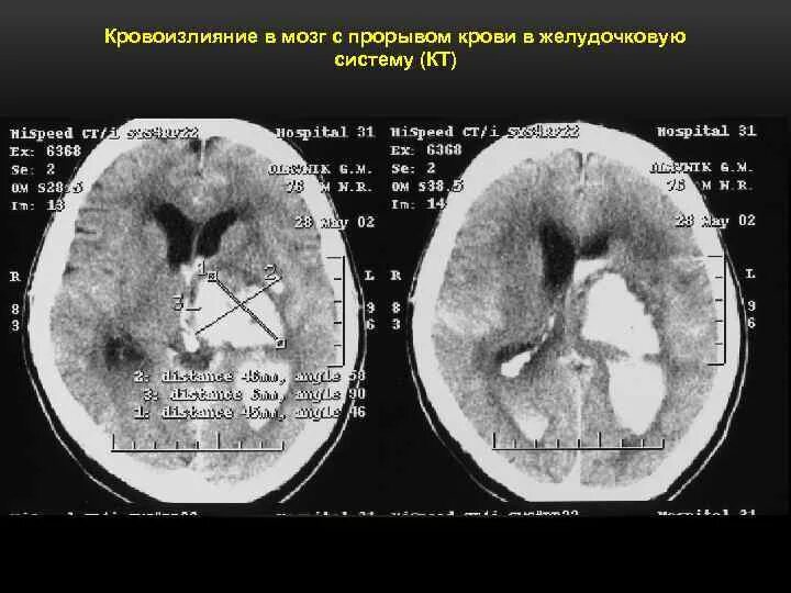 Субарахноидальное кровоизлияние с прорывом в желудочковую систему. Внутримозговая гематома с прорывом в желудочковую систему. Кровоизлияние в желудочки головного мозга. Кровоизлияние в желудочки