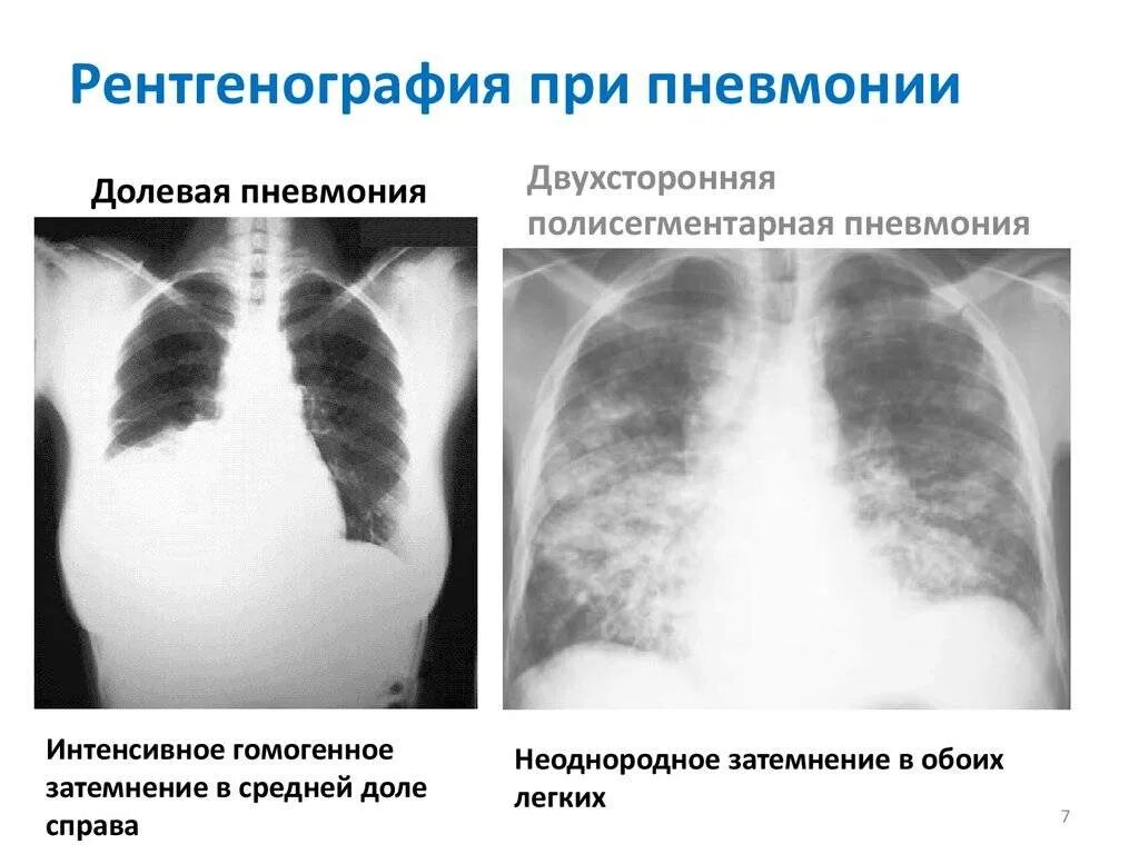 Что значит сегментарная пневмония. Полисегментарная пневмония рентген. полисегментарная двухсторонняя пневмония рентген. рентгеновские снимки при полисегментарной пневмонии. кт двусторонней полисегментарной пневмонии.