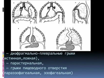 Истинные и ложные грыжи