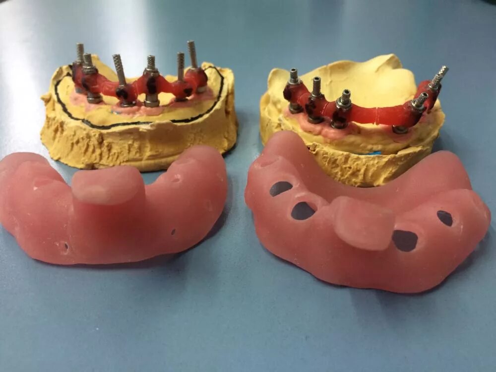 Трансферы чека. Индивидуальная ложка для имплантов. Индивидуальная ложка оттиск имплантат. Слепок с имплантатов индивидуальной ложкой. Разборная модель под имплант.