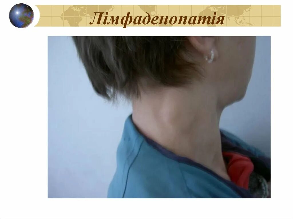 какие лимфоузлы при вич. парвовирус лимфаденит. перечень клинических показаний для обследования на вич инфекцию. какие лимфоузлы при вич. генерализованная лимфаденопатия при вич инфекции.