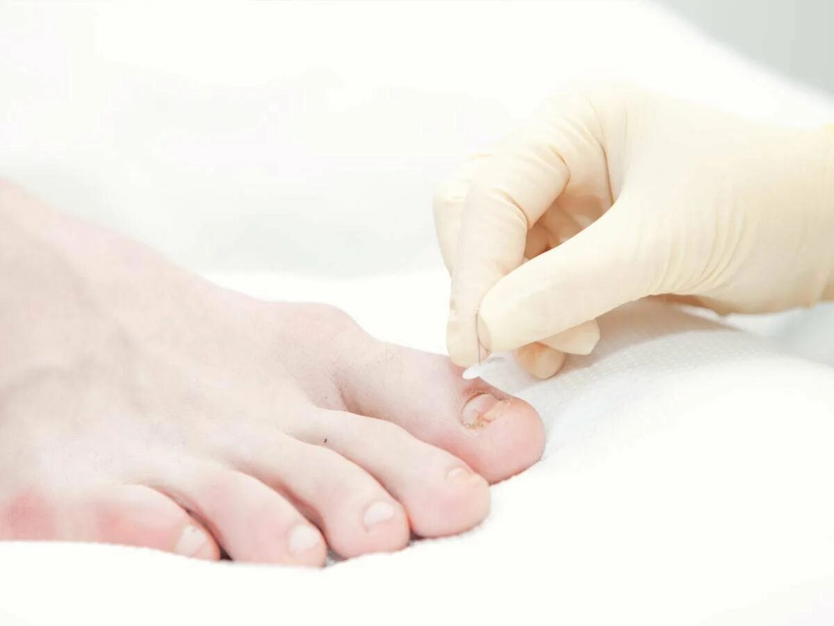 Врач лечение ногтей на ногах. Ноготь врос в палец на ноге. Перевязка вросшего ногтя на ноге.