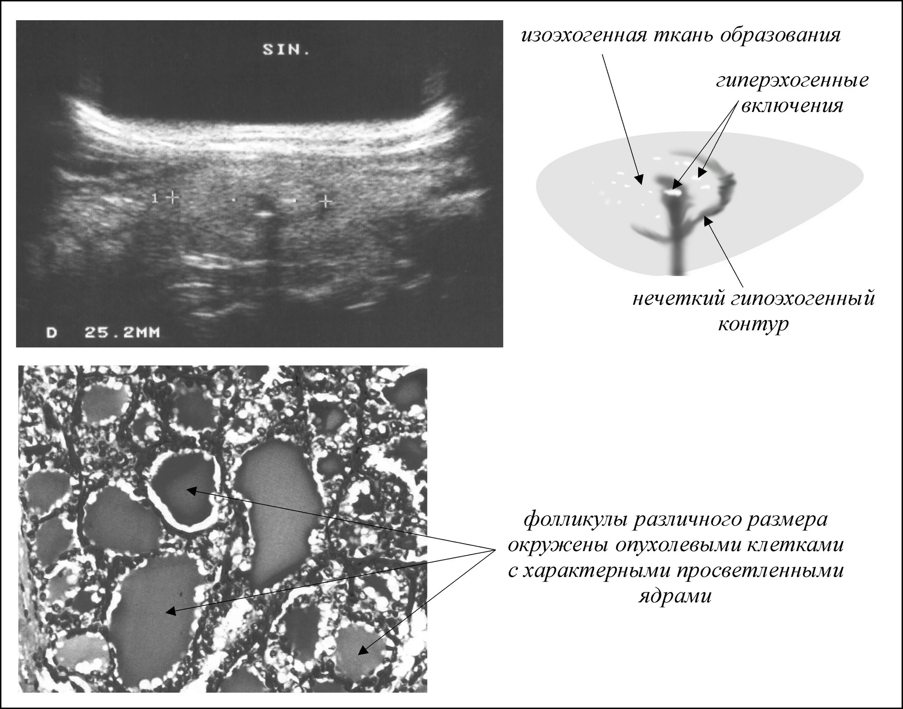 Аваскулярное образование в печени. Изоэхогенное образование щитовидной железы УЗИ. Структура узла изоэхогенная. Изоэхогенный узел щитовидной железы 9 мм. Изоэхогенное образование щитовидной железы что это такое.