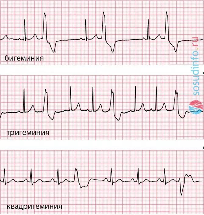 Экстрасистолия бигеминия экг. Предсердная экстрасистолия тригеминия. Экстрасистолия бигеминия тригеминия квадригеминия. Экстрасистолы на экг бигеминия. Тригеминия сердца.