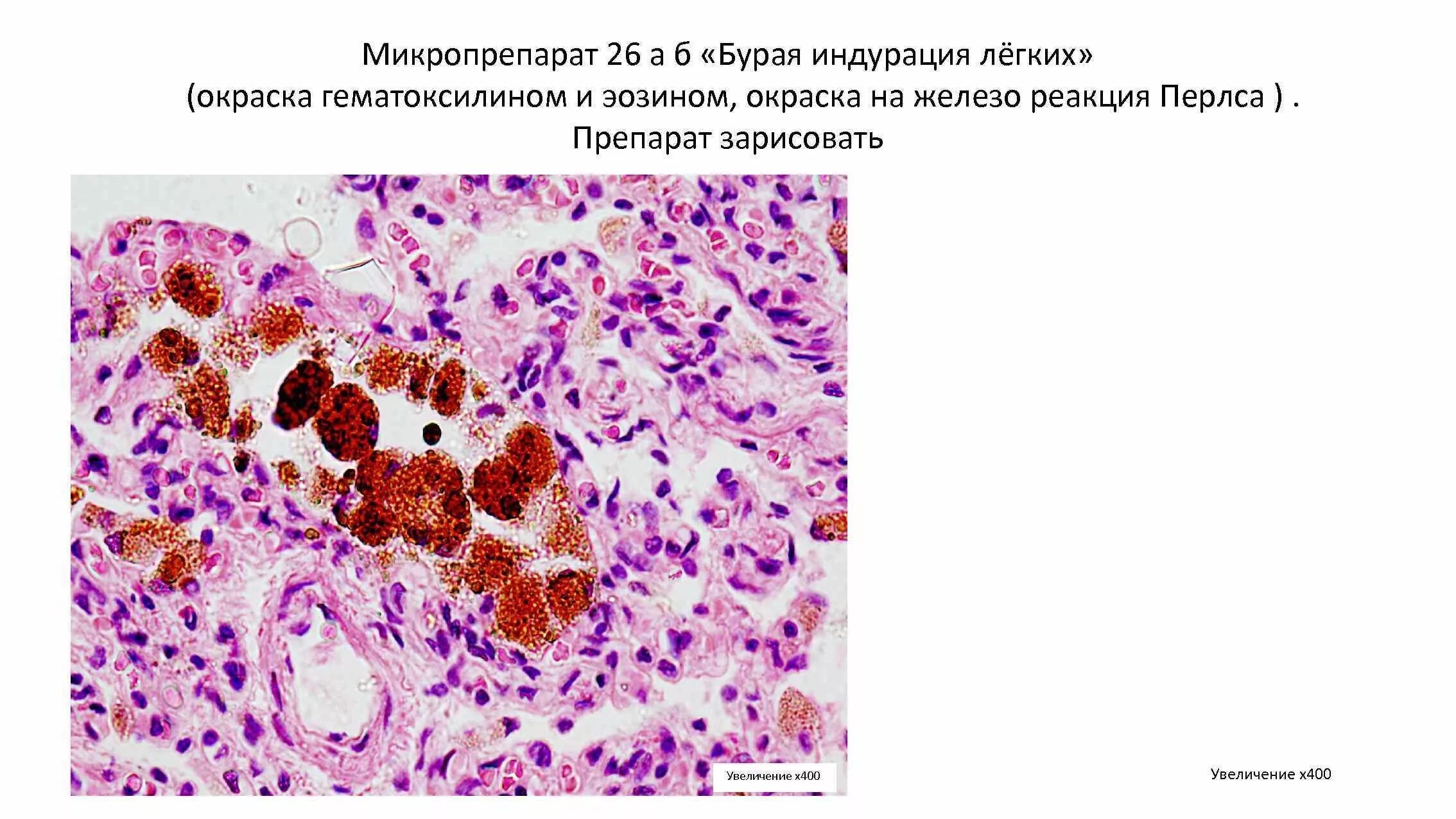 Железо в макрофагах. Бурая индурация легкого макропрепарат. Бурая индурация легких гемосидероз легких макропрепарат. Бурая индурация лёгкого микропрепарат. Бурая индурация легкого патанатомия.