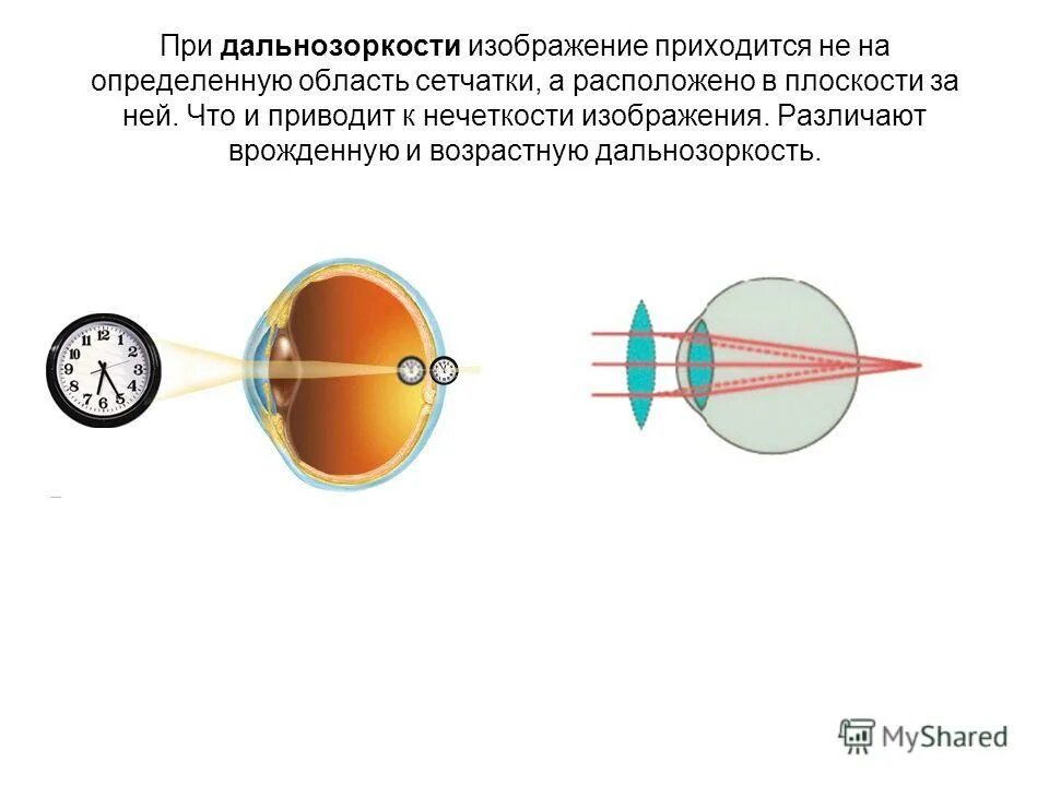 Операция при дальнозоркости. Дальнозоркость. Дальнозоркость изображение. Строение глаза при дальнозоркости. Человек с дальнозоркостью.