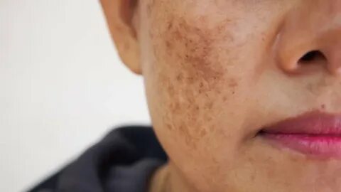Как замаскировать пигментацию на лице