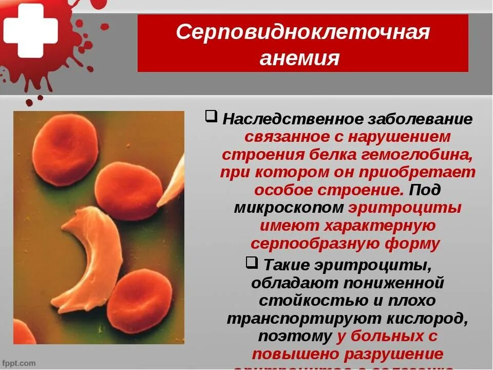 Анемия наследуется. Серповидная клеточная анемия причины. синдром серповидноклеточной анемии причины. эритроциты при серповидноклеточной анемии. серповидноклеточная анемия клинические проявления.