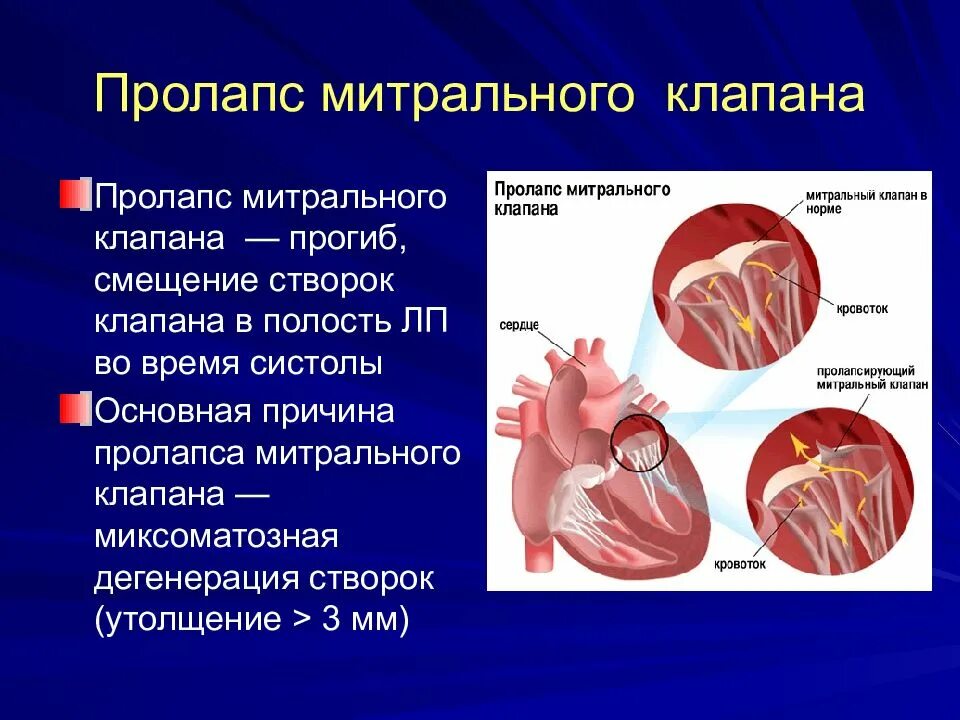 Что такое пролапс митрального клапана. Створки митрального клапана сердца. Пролапс передней створки митрального клапана 3ст. Пролапс нейтрального клапана сердца 1 степени. Функциональная кардиопатия пролапс митрального клапана.