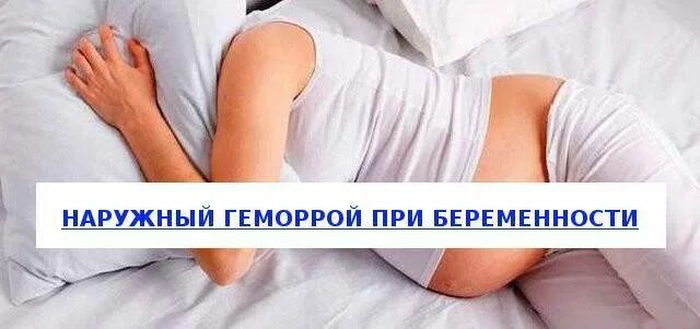 Геморрой при беременности 3 триместр что делать. Наружный геморрой при беременности. наружный геморроидальный узел у беременных. геморрой у беременных 3 триместр.