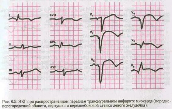 Трансмуральный инфаркт передней стенки. Острый передне перегородочный инфаркт экг. Острый нижний (заднедиафрагмальный) инфаркт миокарда экг. Острый инфаркт передней стенки левого желудочка. Острый инфаркт миокарда передней стенки экг.