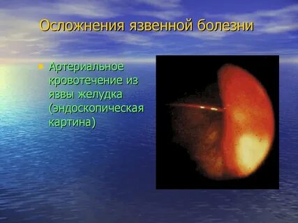 Желудочное кровотечение болезнь