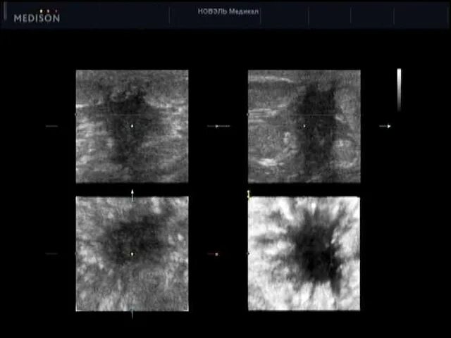 Карцинома грудной железы УЗИ. Карцинома молочной железы на УЗИ. Онкология молочной железы на УЗИ. Новообразование молочной железы на УЗИ. Видна ли опухоль на узи
