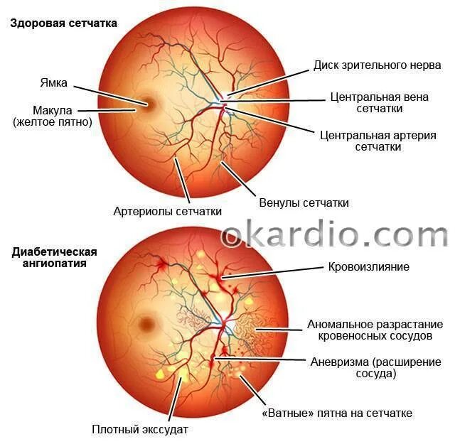 Ангиопатия и ретинопатия сетчатки. Гипертоническая ангиопатия и ретинопатия. Диабетическая офтальмопатия глазное дно. Гипертоническая ангиопатия сетчатки диагноз.