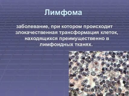 Злокачественные лимфомы