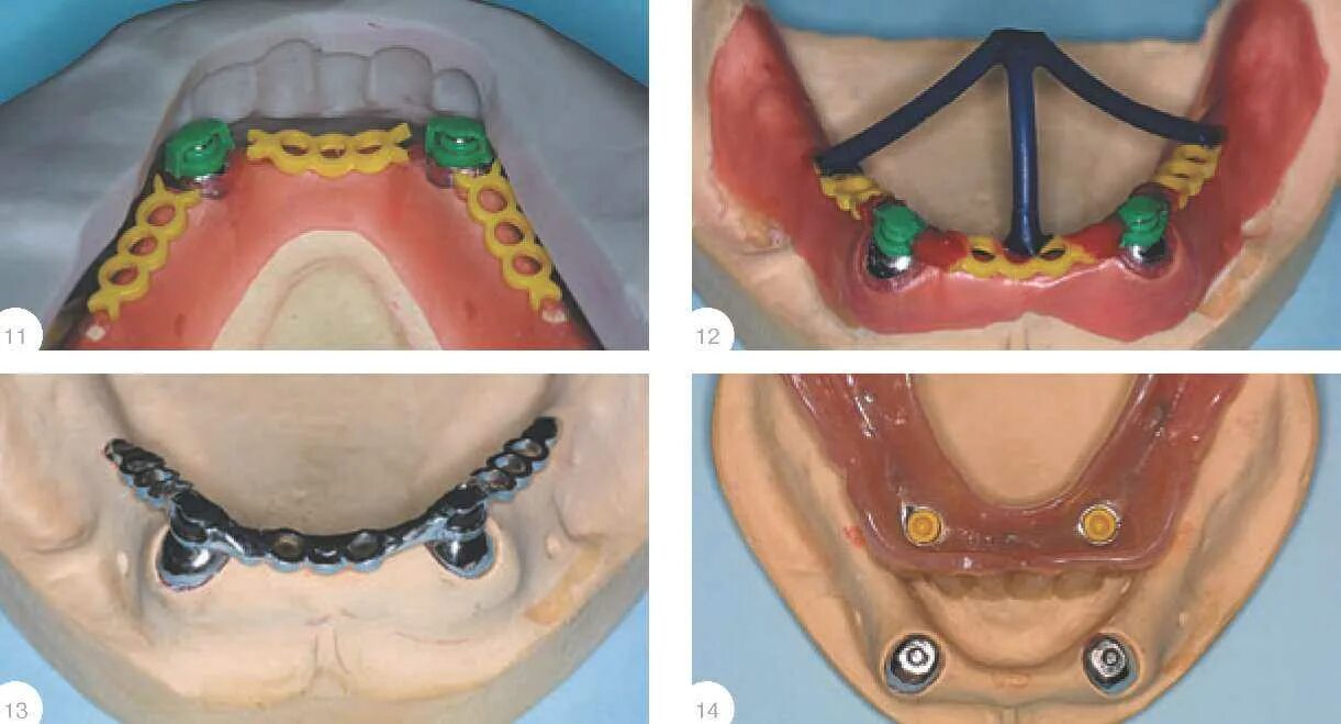 Бюгельный протез с аттачменами. Литниковая система на бюгельный протез нижней челюсти. Ограничитель базиса бюгельный протез. Бюгельный протез на аттачменах матрица и патрица.