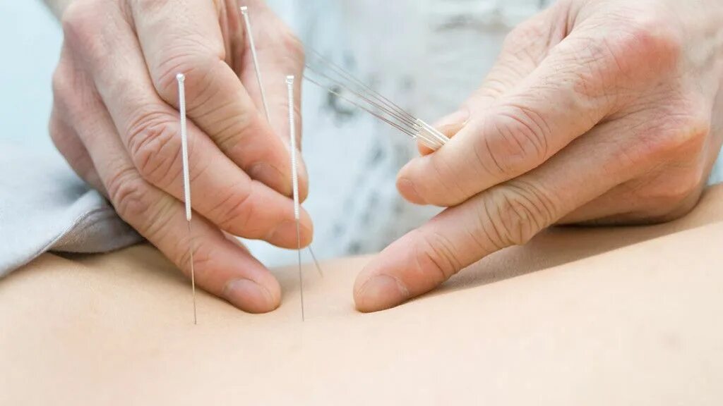 акупунктура от остеохондроза. иглоукалывание тибет. что такое рефлексотерапия. иглоукалывание тибет. акупунктура.