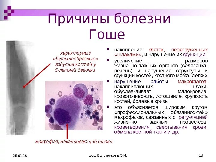 Селезенка при болезни Гоше микропрепарат. Клетка при болезни Гоше. Болезнь Гоше патологическая анатомия. Селезенка при болезни Гоше. Все клетки больного мужчины имеют 47