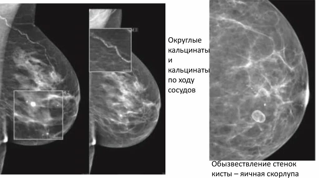 Причина образования кальцинатов. Причина образования кальцинатов