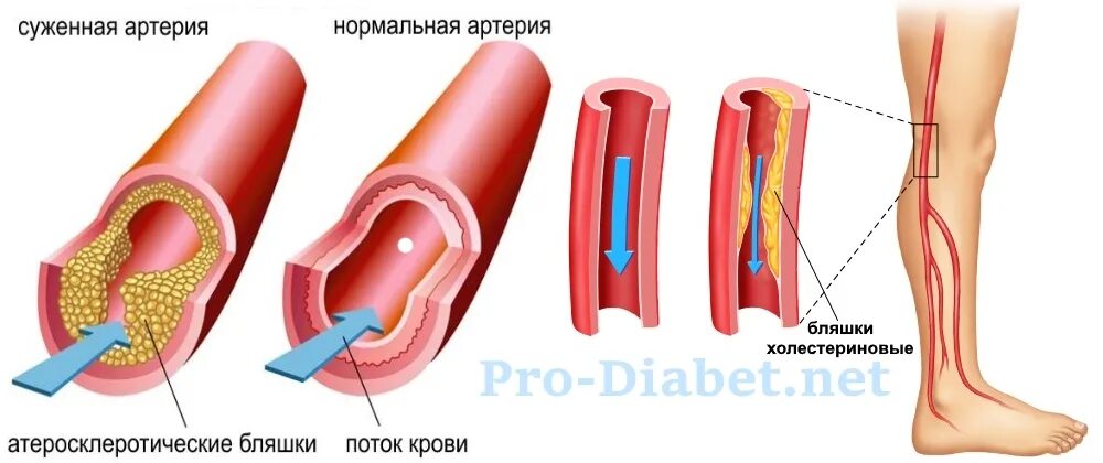 Быстрое расширение сосудов. Гиперхолестеринемия это атеросклероз. Облитерирующий атеросклероз нижних конечностей. Атеросклероз (закупорка кровеносных сосудов). Атеросклероз при гиперхолестеринемии.