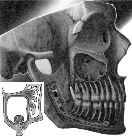 Костная стенка которая отделяет полость рта. Гайморова пазуха верхней челюсти. Верхнечелюстная пазуха анатомия. Гайморова пазуха анатомия. Перфорация гайморовой пазухи на рентгене.