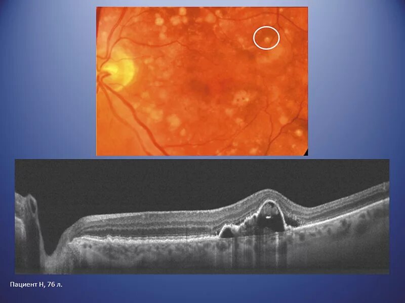 Лечение дегенерации макулы. Неоваскулярная макулодистрофия. Неоваскулярная мембрана сетчатки. Субретинальная неоваскулярная мембрана. Неоваскулярная мембрана сетчатки окт.