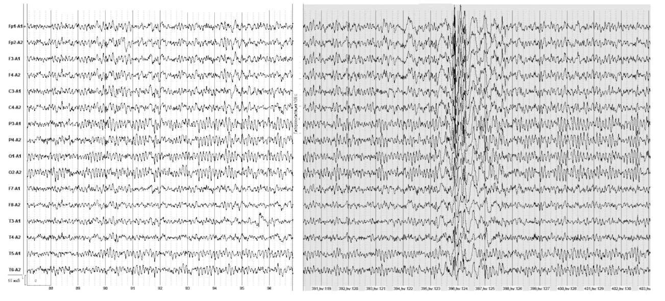 Гипервентиляция при эпилепсии. Пик волна на ЭЭГ генерализованный разряд. Острая медленная волна типа Дэрд. Медленные волны на фоне гипервентиляции. Медленные волны на ээг