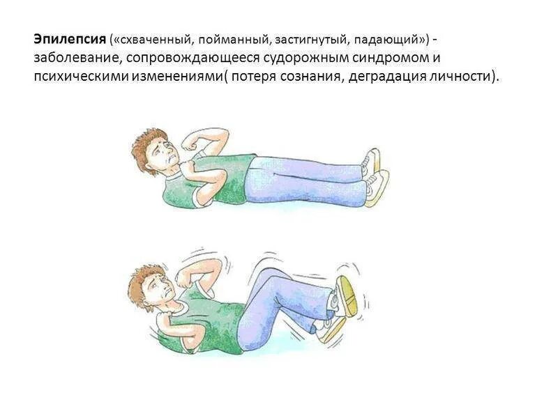 Как проявляется приступ эпилепсии. Припадок эпилепсии симптомы.