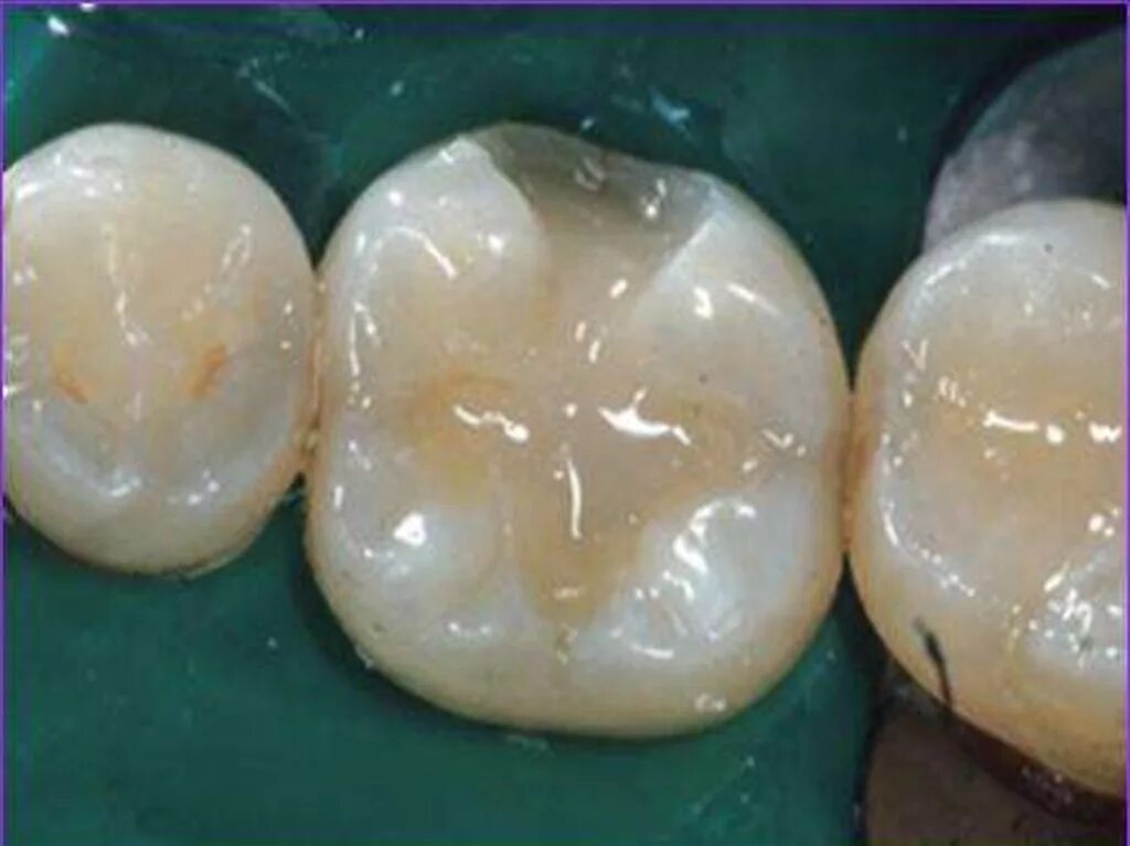 Адгезивным краем. Адгезивный зубной мост. Простыня фолиодрапе стерильная. Тотальное протравливание эмали это. Адгезивным краем.