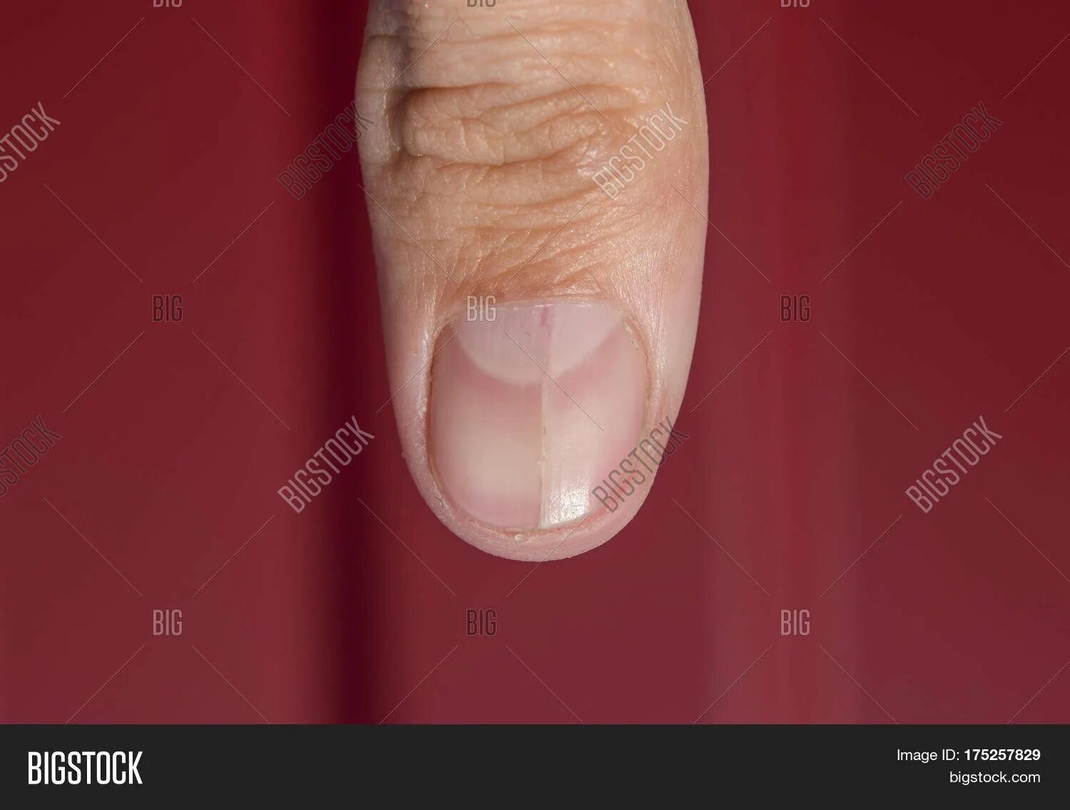 Борозды бо-рейля на ногтях. Болезни ногтей на руках таблица. Этапы формирования атеросклеротической бляшки схема. Расщепление матрикса. Структура ногтя.