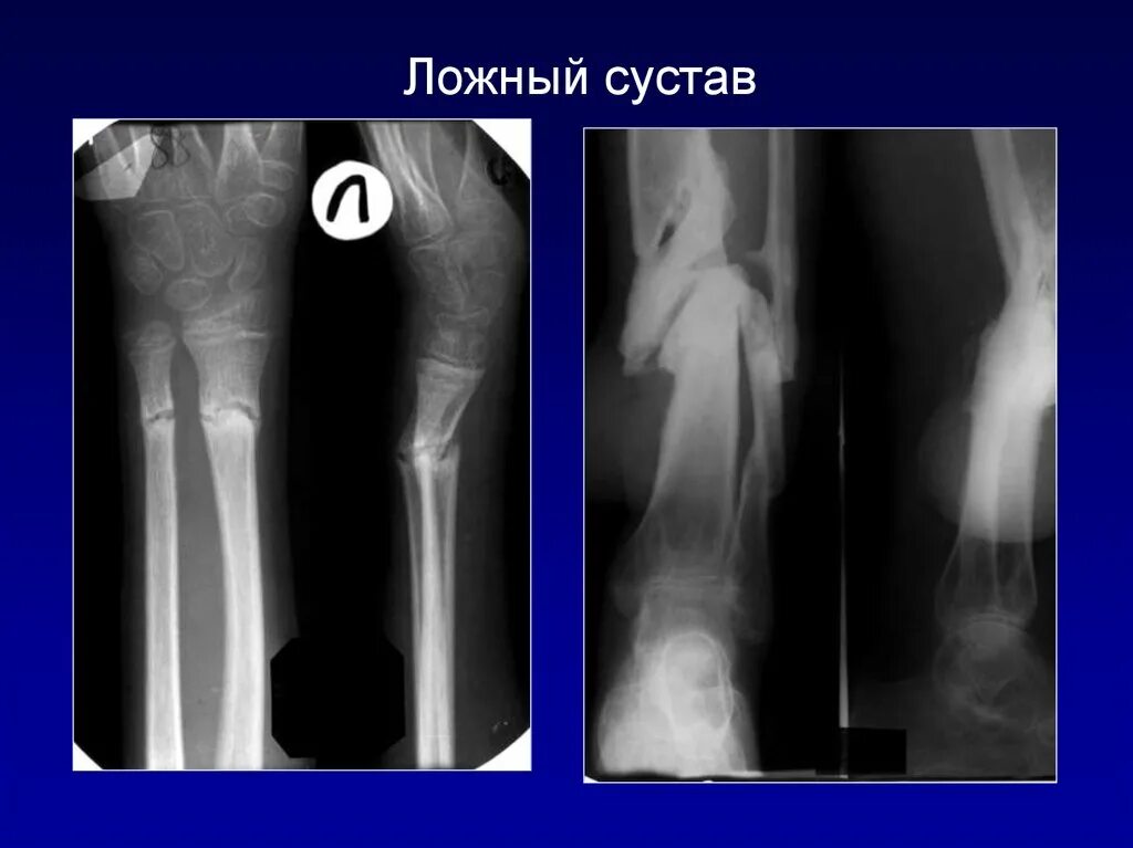 Ложный сустав большеберцовой кости рентген. Ложный сустав рентгенодиагностика. Ложный сустав большеберцовой кости. Ложный сустав рентген признаки.