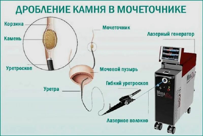 Сколько стоит операция по удалению камней. Дробление камней в мочеточнике ультразвуком. Дробить камни в мочеточнике ультразвуком. Дробление камня в почке через мочеточник. Дробление камней в мочеточнике лазером.