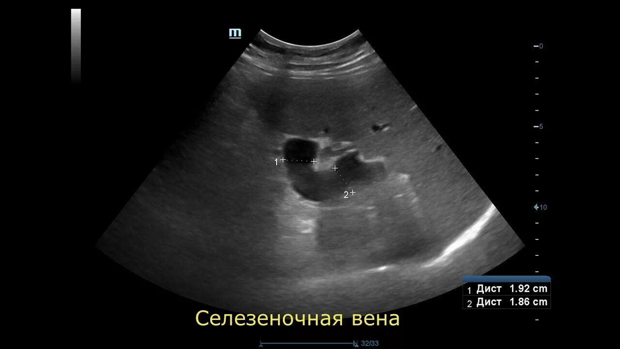 Расширение селезеночных вен. Норма селезеночной вены на УЗИ. Тромбоз селезеночной вены на УЗИ.