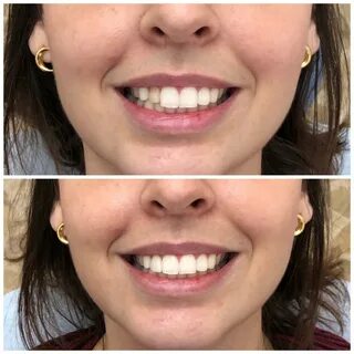 Dentes Antes E Depois Aparelho.