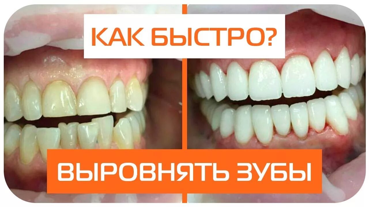 Можно ли выровнять зубы взрослому. Как быстро выровнять зубы.