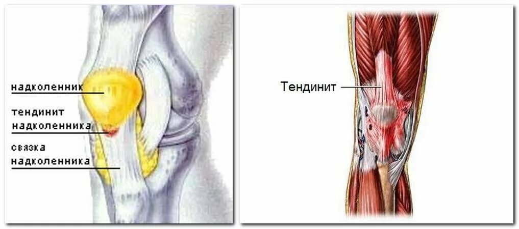 Тендинит коленных связок