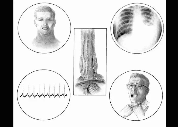 Спонтанный разрыв пищевода синдром Бурхаве. Ранения пищевода травмы. Банкетная травма пищевода. Разрыв нижней трети пищевода. Синдром пищевода