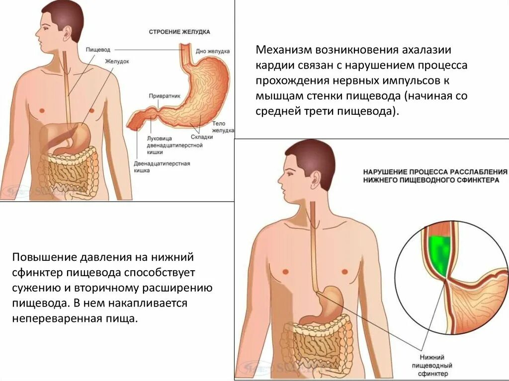 Пищевода тошнота