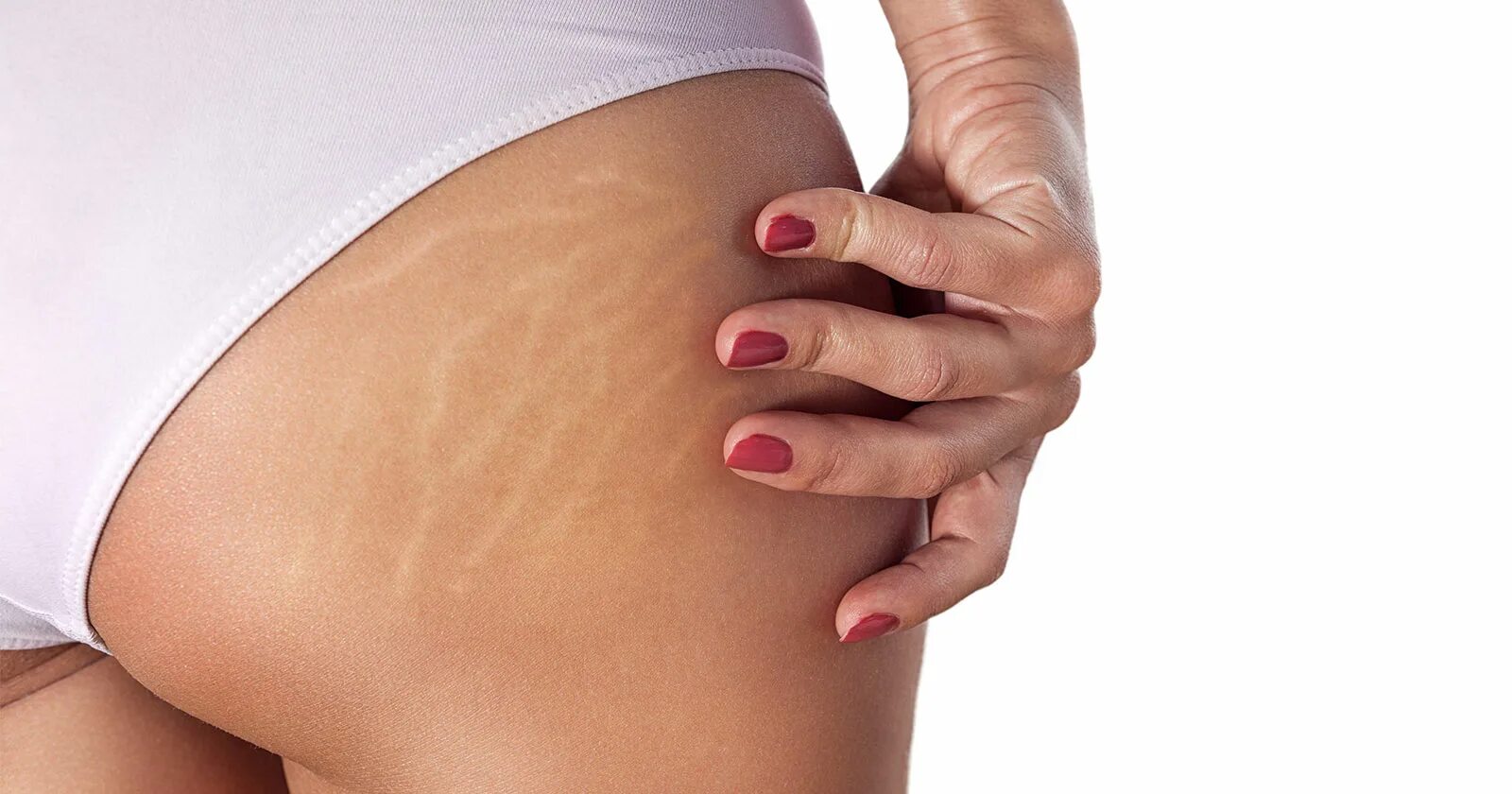 Растяжки stretch marks. Маленькие растяжки на бедрах.